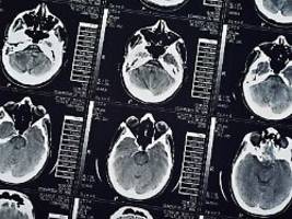 Vergleich spezieller MRT-Scans: Post-Covid-Symptome sind im Gehirn sichtbar