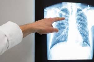 etwas mehr tuberkuloseerkrankungen 2022 in bayern