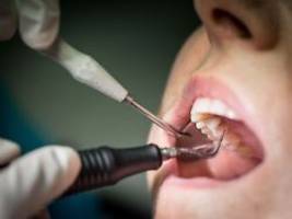 Einschränkungen beachten: Wie sinnvoll ist eine Zahnzusatzversicherung?