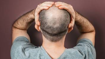 Hoffnung auf neue Therapien - Forschende finden Gene, die Haarausfall bei Männern verursachen