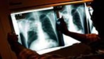 weltgesundheitsorganisation: who meldet anstieg von tuberkulose-fällen während corona-pandemie
