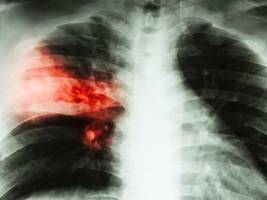 Gesundheit: Der Krieg ist der beste Freund der Tuberkulose