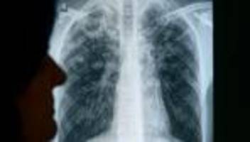 gesundheit: tuberkulose-erkrankungen in sachsen konstant