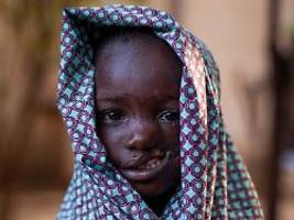noma zerfrisst das gesicht: diese infektion tötet jährlich zehntausende kinder
