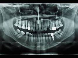 Schock für Patient in Türkei: Zahnarzt bohrt Schraube bis ins Gehirn
