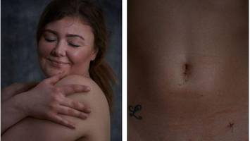 endometriose: fotografin will krankheit ein gesicht geben