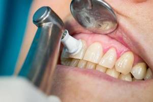 Ursache für Zahnfleischbluten: Dieser Vitamin-Mangel kann schuld sein