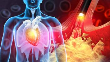 bluthochdruck oft unerkannt - leiser killer gefährdet millionen deutsche – 6 maßnahmen schützen sie