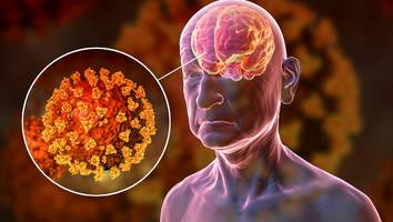 Schock-Studie zeigt - Corona lässt Gehirn um 20 Jahre altern – wen das vor allem trifft