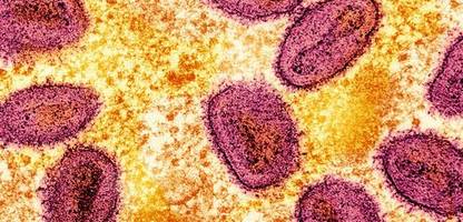 Erster Fall von neuer Mpox-Variante in Deutschland