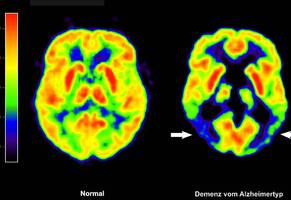 Alzheimer-Medikament Lecanemab: „Das Medikament ist ein Fortschritt, es kann den Krankheitsverlauf aufhalten“