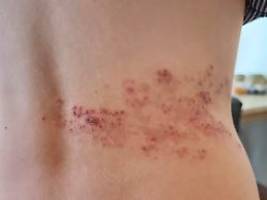 schmerzhaft und ansteckend: woran erkennt man eine gürtelrose?