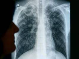 durch kürzungen bei hilfsgeldern: who: zusammenbruch der tuberkulose-programme droht