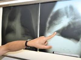 Krankenkassen zahlen: Lungenkrebs-Früherkennung für Raucher kommt - unter Bedingungen