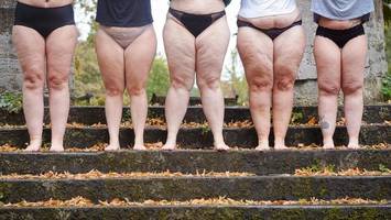 Habe ich ein Lipödem oder Cellulite? Ärztin erklärt Symptome