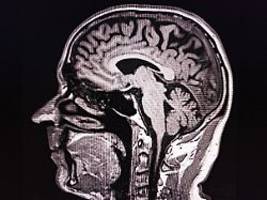 Mit Hirnscan aus der Lebensmitte: Neues KI-Tool sagt individuelles Sterberisiko voraus
