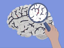 Medizin: Wie fängt Alzheimer an?