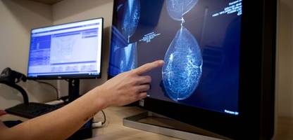 Brustkrebs: Mammografie-Screening senkt Sterblichkeit deutlich