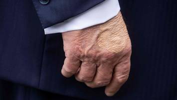Seltsamer Fleck an Trumps Hand sorgt für Spekulationen