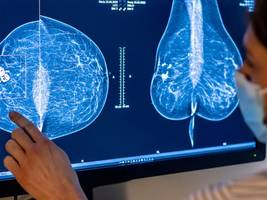 brustkrebs: mehr mitsprache, weniger eile: was patientinnen nach einer dcis-diagnose wirklich brauchen