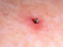 Häufigste Infektion durch Zecken: Was steckt hinter der Erkrankung Lyme-Borreliose?