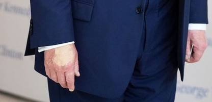 donald trump: weißes haus dementiert gerüchte wegen hand-verfärbung