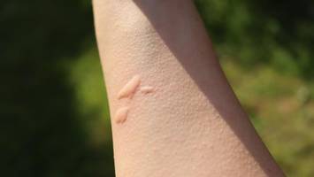 im test: stiftung warentest entlarvt nutzlose insektenstichheiler