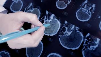 neues medikament gegen alzheimer: experten mit klarer erwartung