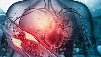 Cholesterin senken mit Statinen: Ärztin warnt vor „Angstmache“