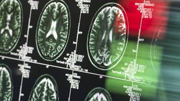 Multiple Sklerose: Neurologe sagt, wie man Frühsymptome erkennt