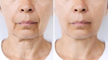 „Ozempic-Face“ – ein unerwarteter Preis der Abnehmspritzen?