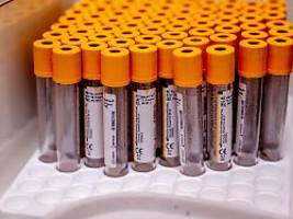 Organschäden, Demenz, Erblindung: Syphilis-Infektionen erreichen 2024 neuen Höchststand