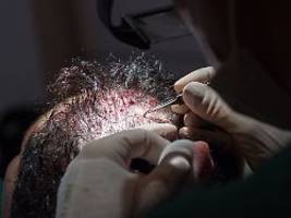Bei medizinischer Indikation: Kann die Haartransplantation von der Steuer abgesetzt werden?