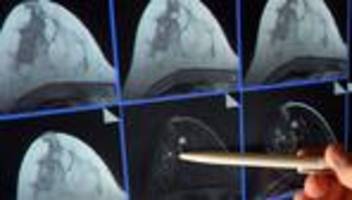 Medizin: Hohe Kosten: Land erwägt Reform der Krebsregistrierung