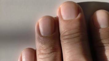 vitamin b12: warum ein mangel demenz und lähmungen auslösen kann