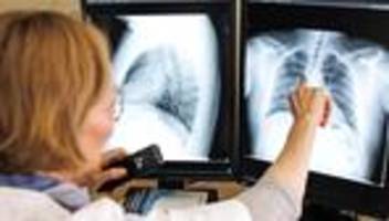 Gesundheit: WHO meldet weniger Tuberkulose-Infektionen