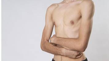 essstörungen bei männern – häufig bleiben sie unerkannt