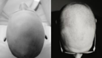 Haarausfall: Als ich meine Hochzeitsfotos sah, dachte ich: Es ist aus