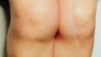 arthrose: beschädigter gelenkknorpel heilt kaum von selbst