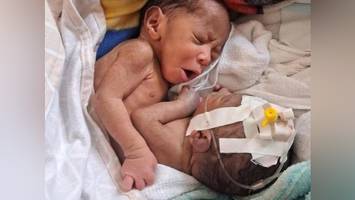 Siamesische Zwillinge: Können deutsche Ärzte den Babys helfen?