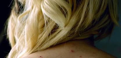 akne-impfung: suche nach der anti-pickel-spritze