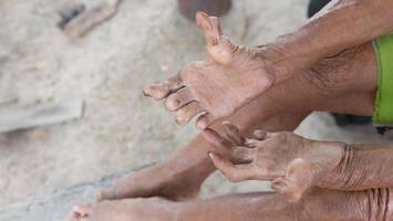 Nach 30 Jahren wieder Lepra in Europa – das sagen Experten zum Infektionsrisiko