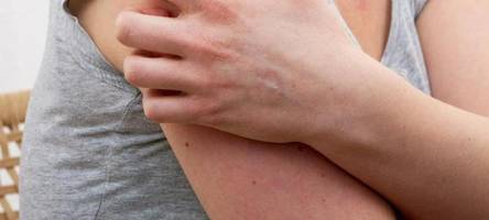 Impf-Durchbrüche bei Windpocken sind offenbar keine Seltenheit