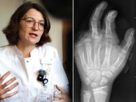 arbeitsreichste nacht: handchirurgin: böllerverletzungen werden schlimmer