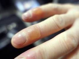 erfrierungen und frostbeulen: warum eine unterkühlung ein notfall ist und wie man sich schützt