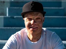 Überleben nach einer brandverletzung: „sobald ich mich draußen bewegte, spürte ich die blicke“