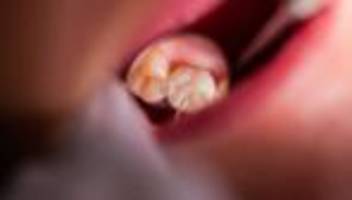 Medizin: Zahl der Zahnmediziner in Mecklenburg-Vorpommern sinkt