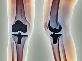 prothesen: schwerhörig wegen der knie-op?
