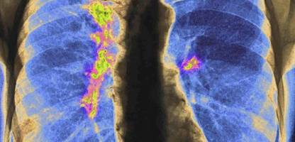 Krebs: Was neue Zahlen über die Krankheit verraten