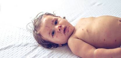 Masern: Fallzahlen in Europa und Zentralasien stark gesunken – aber WHO bleibt besorgt